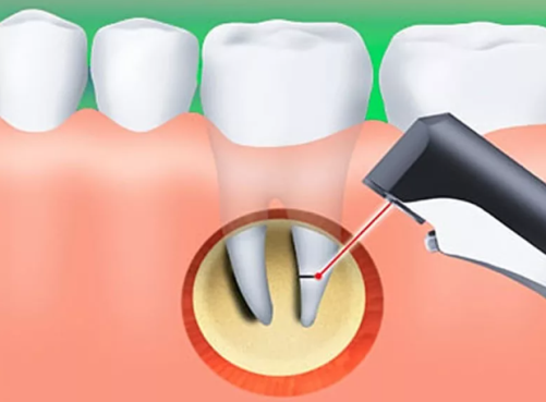 Endodontic Retrograde Surgery: Treatment and Removal of Infected Root Tips